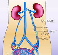 Red Light Therapy for Pelvic Congestion Syndrome